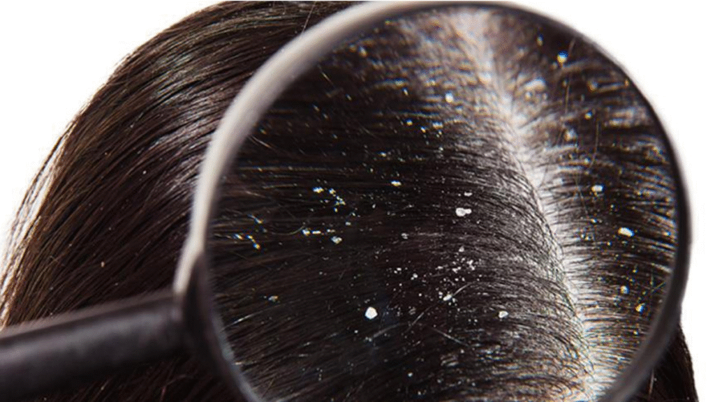 how to cure dandruff naturally