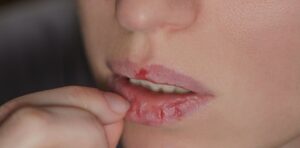 Chapped lips in winter due to dryness and low humidity